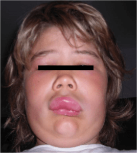 Fig.2 Angioedema localizzato al volto